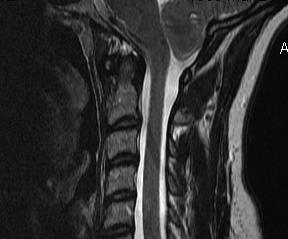 Arnold Chiari Type 1 MRI
